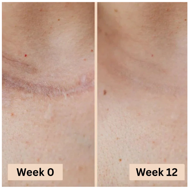 PureSkin Lab - Stick in silicone per la risoluzione delle cicatrici