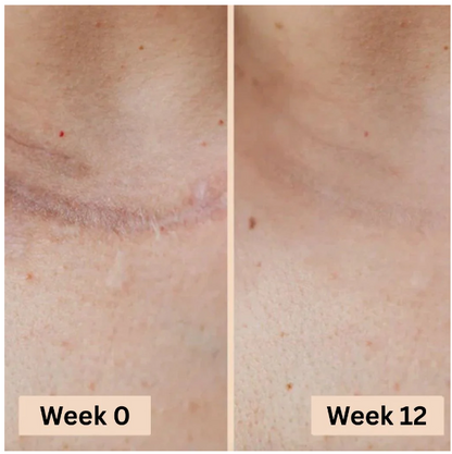 PureSkin Lab - Stick in silicone per la risoluzione delle cicatrici