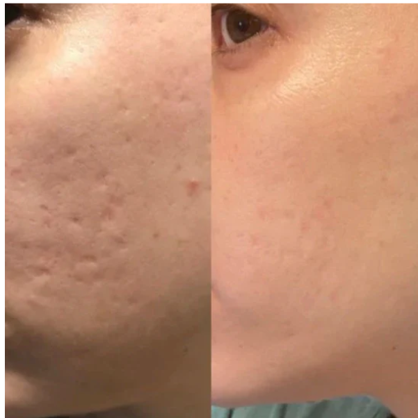 PureSkin Lab - Stick in silicone per la risoluzione delle cicatrici