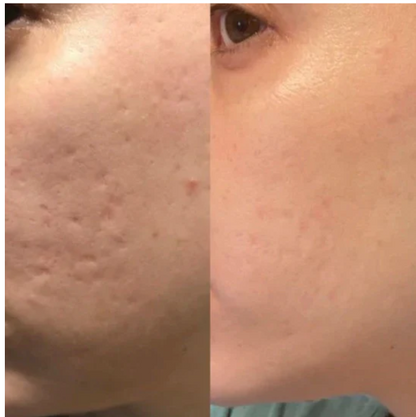 PureSkin Lab - Stick in silicone per la risoluzione delle cicatrici