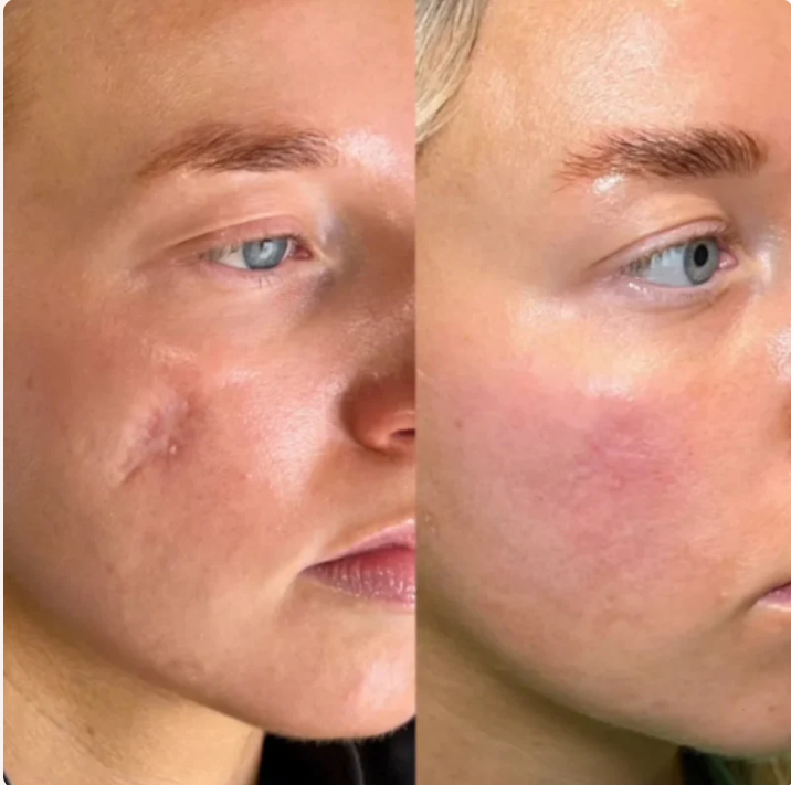 PureSkin Lab - Stick in silicone per la risoluzione delle cicatrici