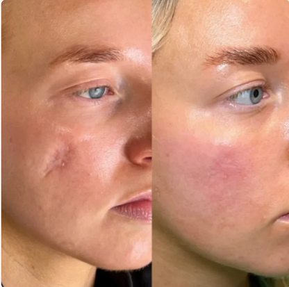 PureSkin Lab - Stick in silicone per la risoluzione delle cicatrici